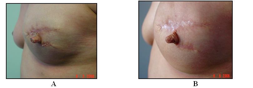 Nipple–Areolar Reconstruction
