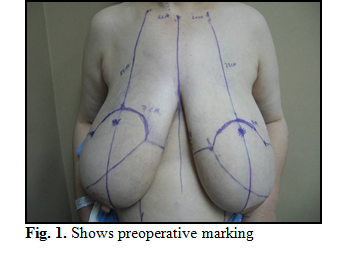 BREAST SURGERY LECTURES part 8, Mastalgia #breast_surgery #breast